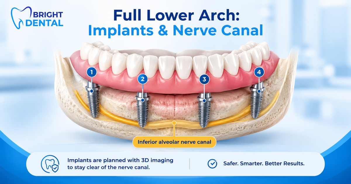 Diagram of four numbered lower jaw implants placed clear of the inferior alveolar nerve canal