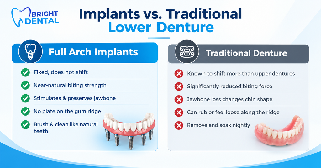 Comparison chart of full arch implants versus a traditional lower denture, listing stability, biting strength and jawbone benefits