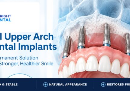 Full upper arch dental implants model showing titanium posts supporting a fixed denture