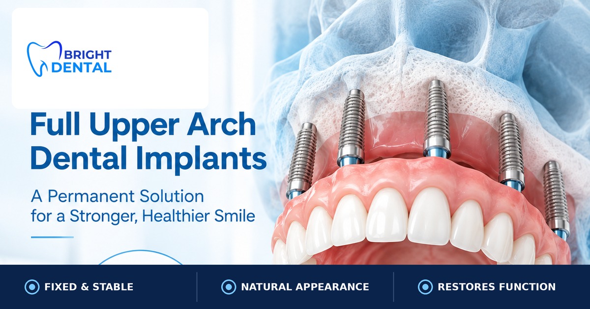 Full upper arch dental implants model showing titanium posts supporting a fixed denture