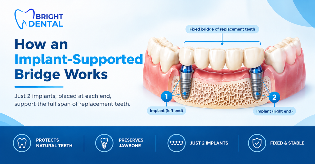 Diagram of an implant-supported bridge with two implants at each end of the gap supporting a fixed bridge of replacement teeth