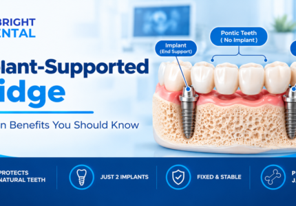 Implant-supported bridge with one implant at each end supporting pontic teeth in between, with benefits listed below