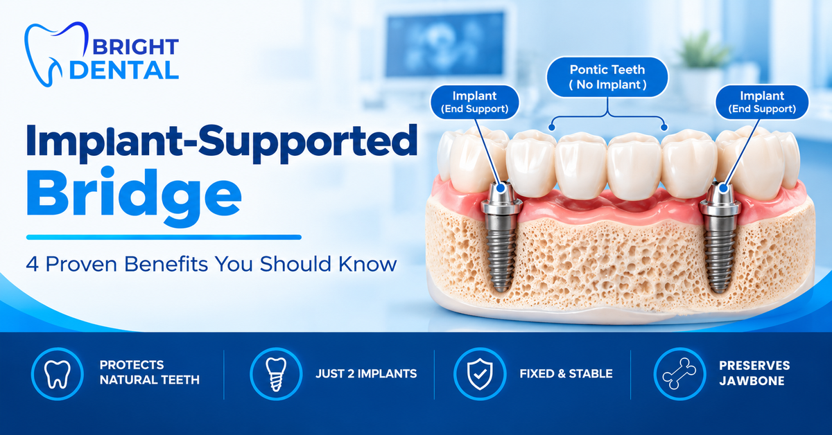Implant-supported bridge with one implant at each end supporting pontic teeth in between, with benefits listed below