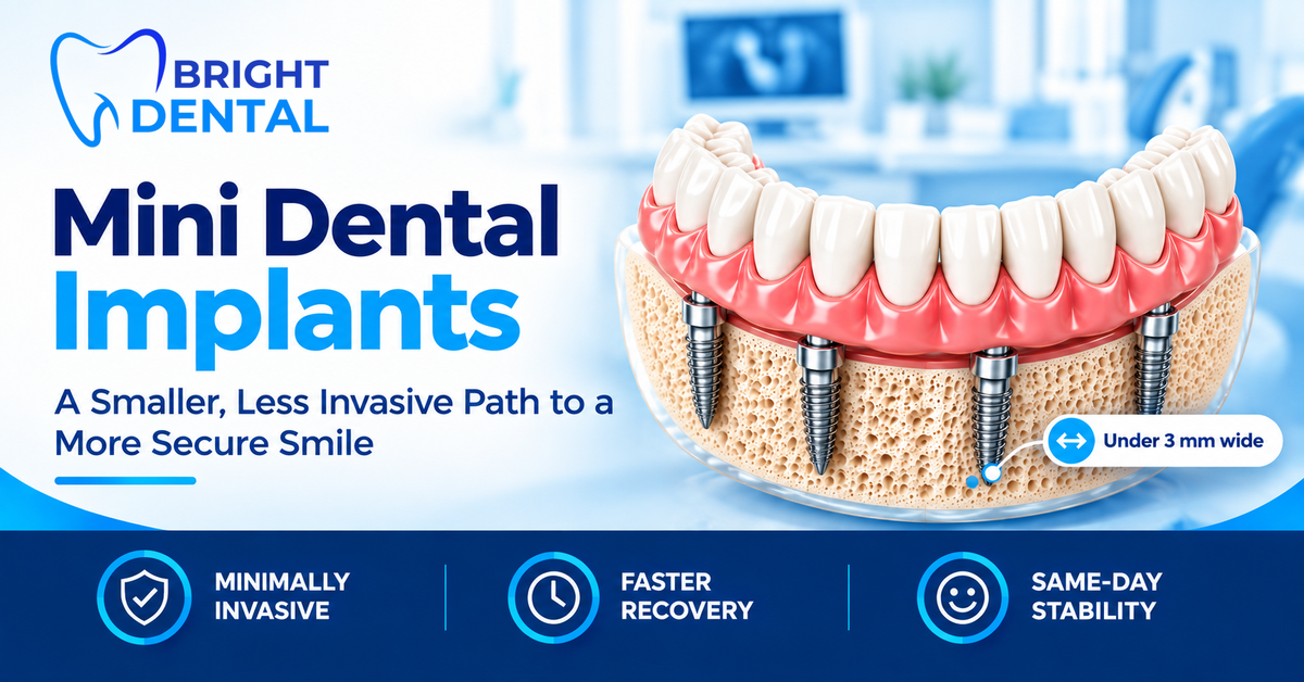 Mini dental implants supporting a lower denture, with four narrow implants placed in the jawbone